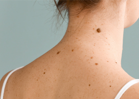 What You Should Know About Skin Spots